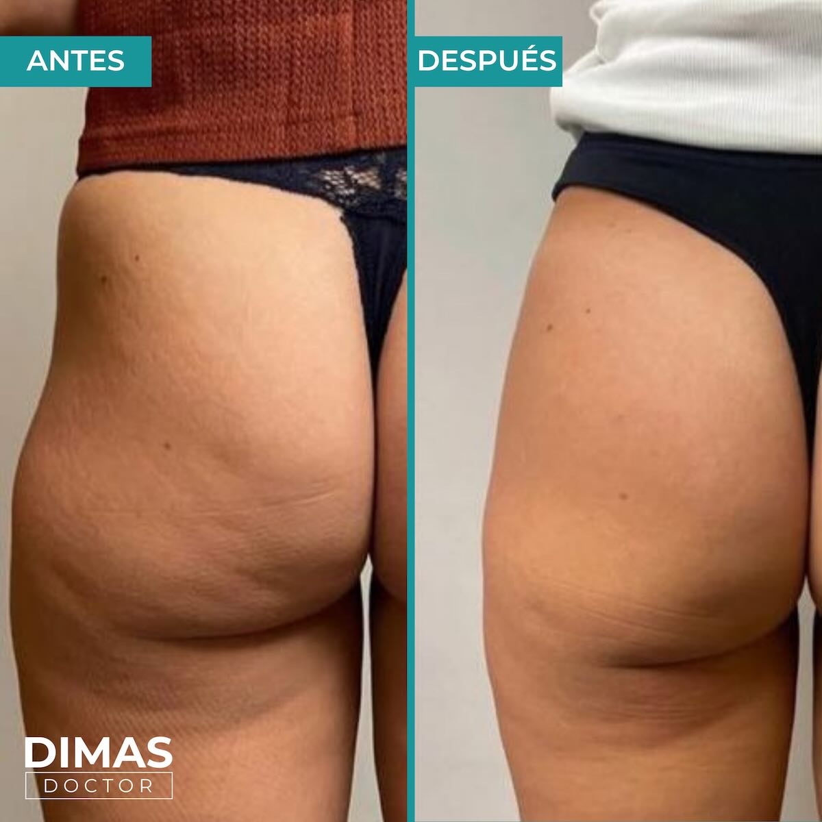 Vista de glúteos de espaldas con ropa interior de antes y después del tratamiento de aumento con ácido hialurónico
