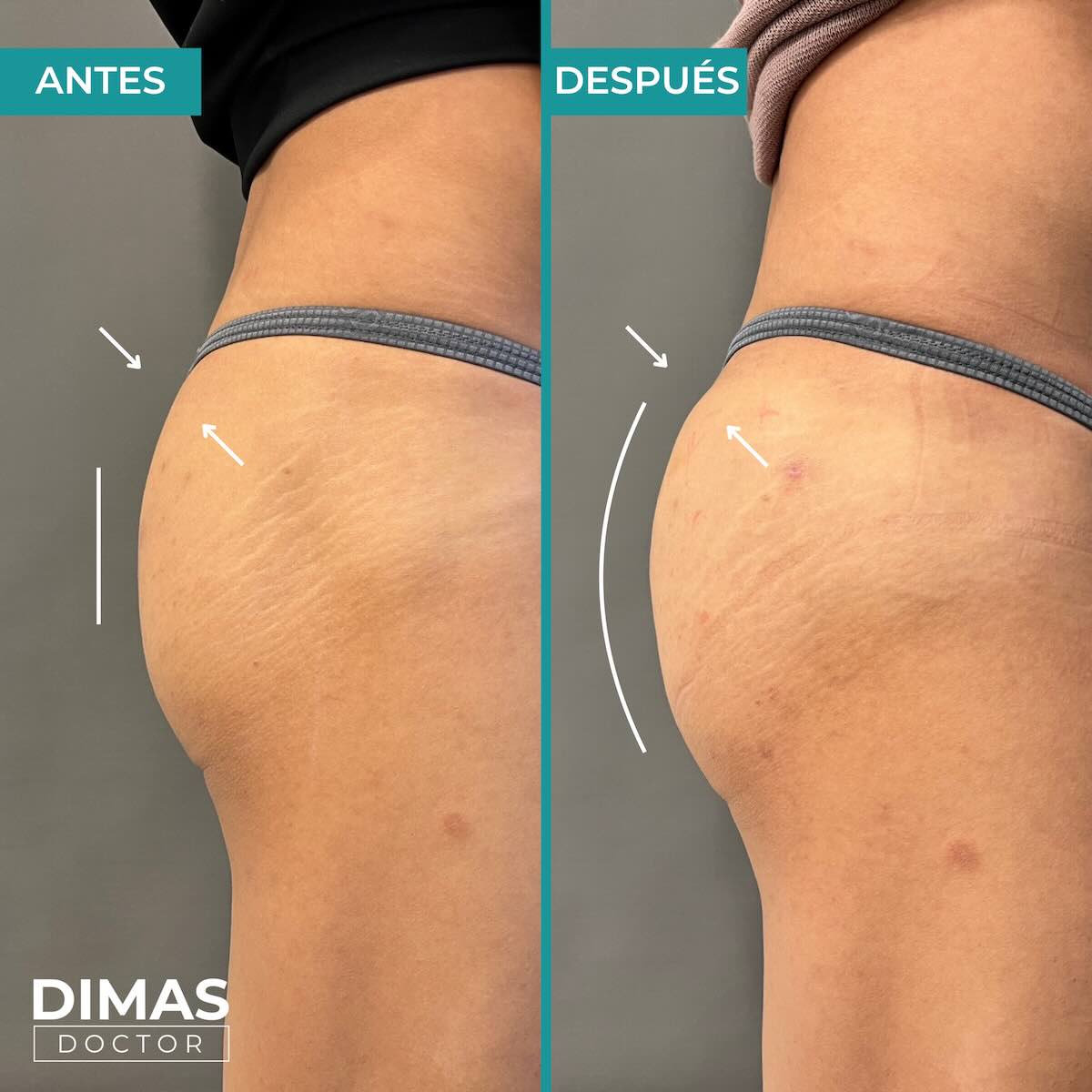 Antes y después del tratamiento de aumento de glúteos con ácido hialurónico en Barcelona