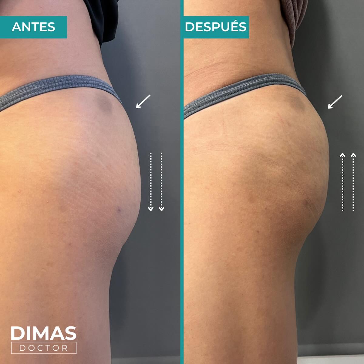 Antes y después del tratamiento de aumento de glúteos con ácido hialurónico en Barcelona