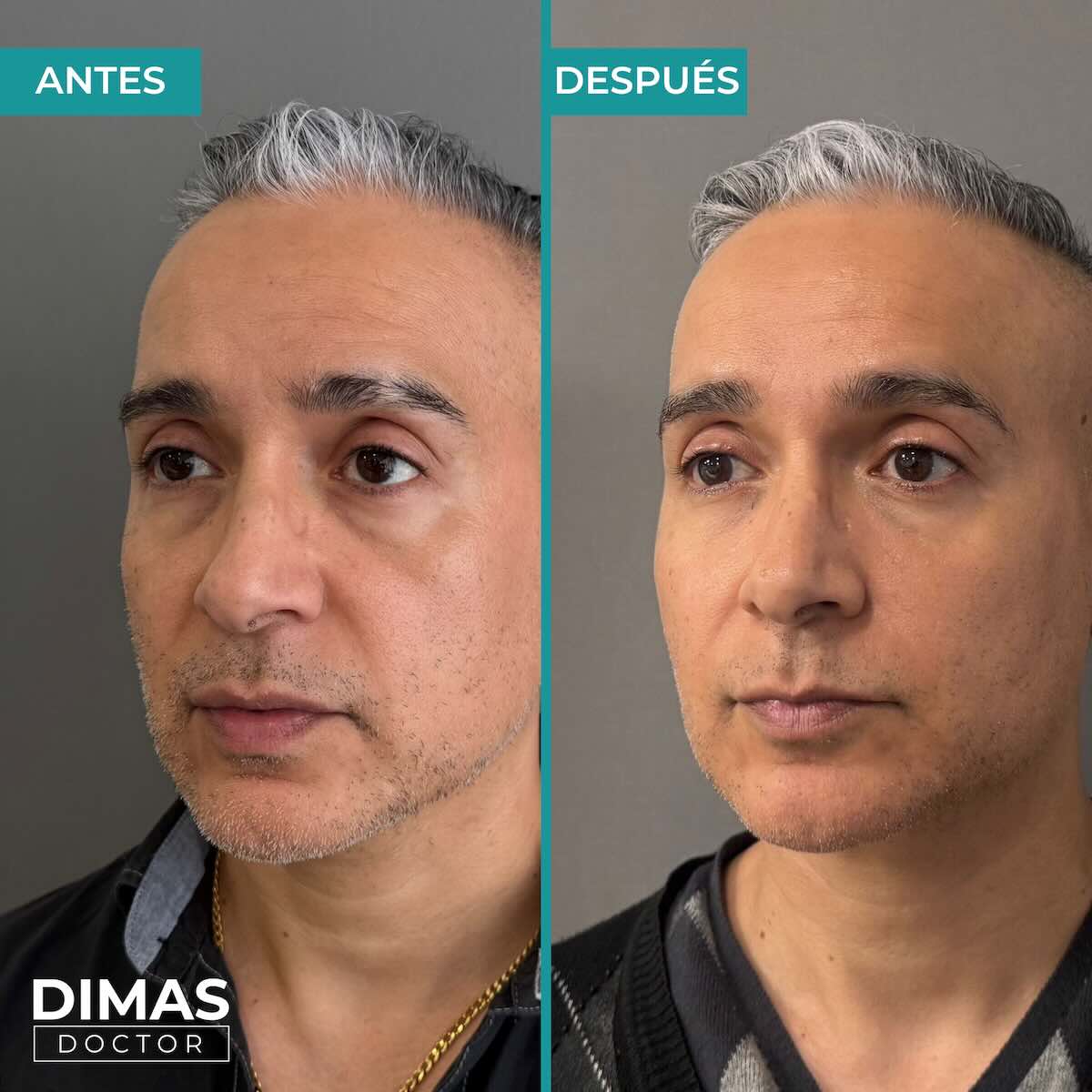 Antes y después de tratamiento con ácido hialurónico puntos de anclaje en hombre