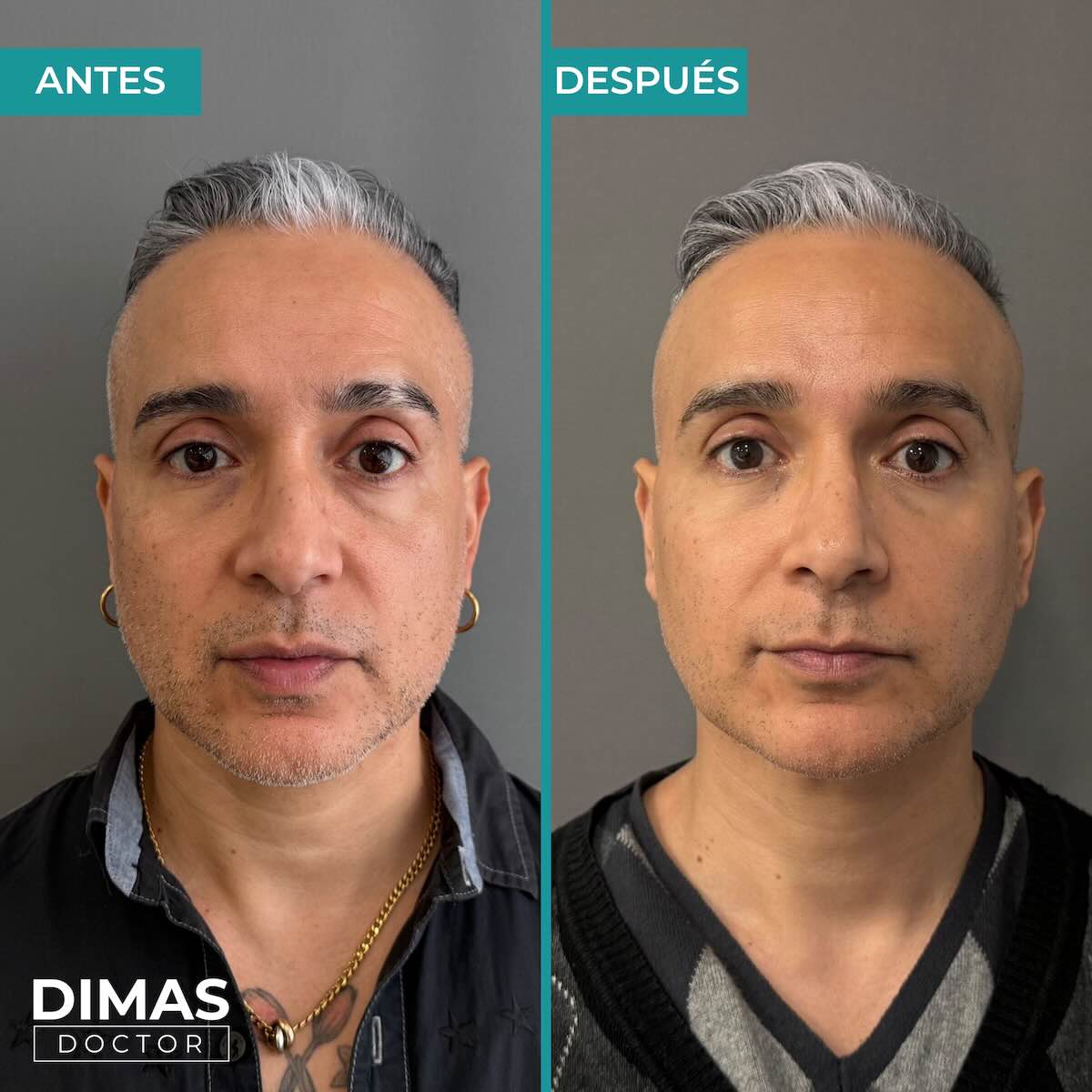 Antes y después de tratamiento con ácido hialurónico puntos de anclaje en hombre