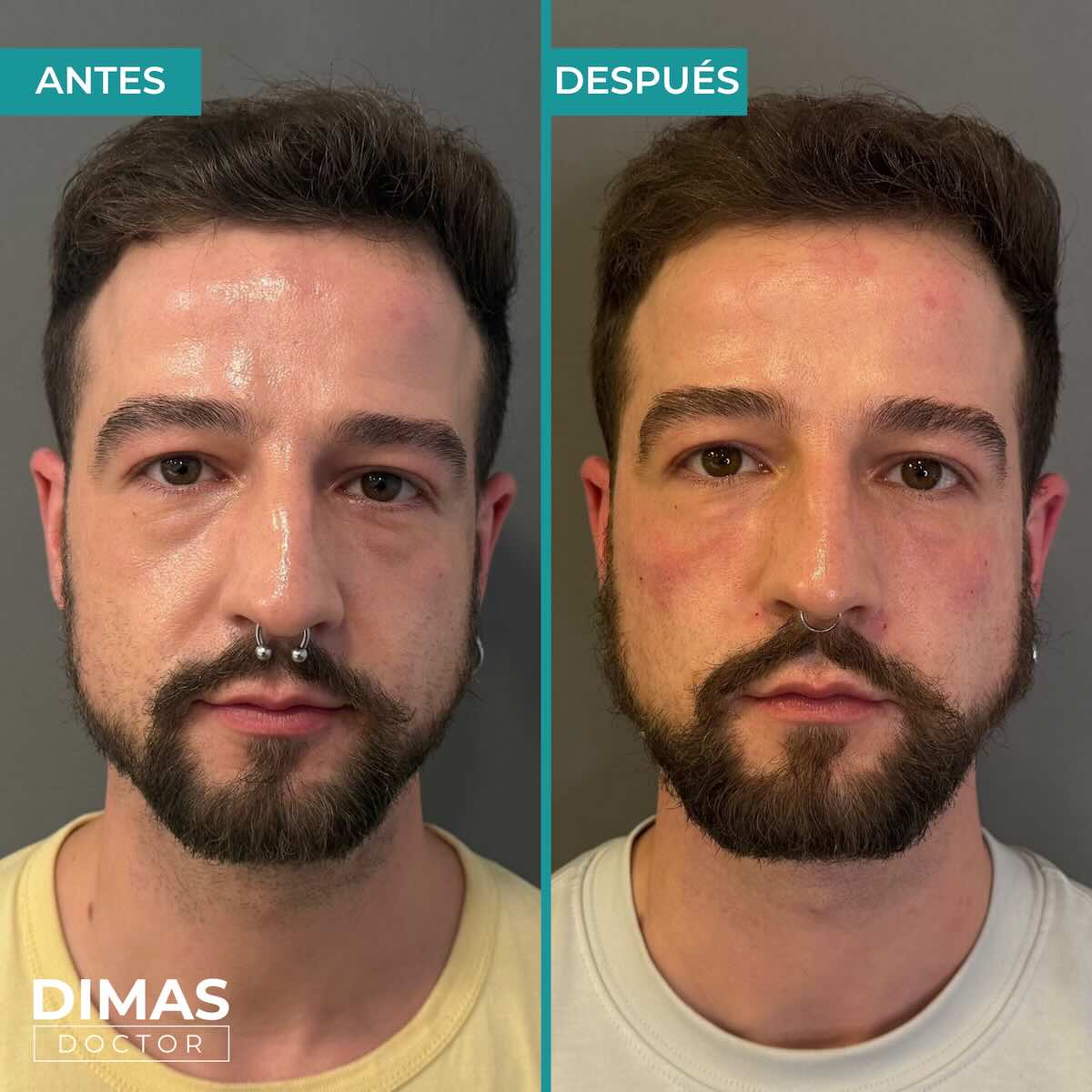 Antes y después de tratamiento con ácido hialurónico puntos de anclaje en hombre