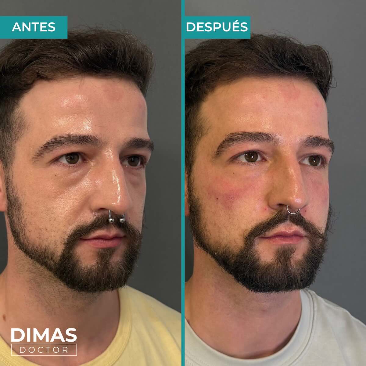 Antes y después de tratamiento con ácido hialurónico puntos de anclaje en hombre