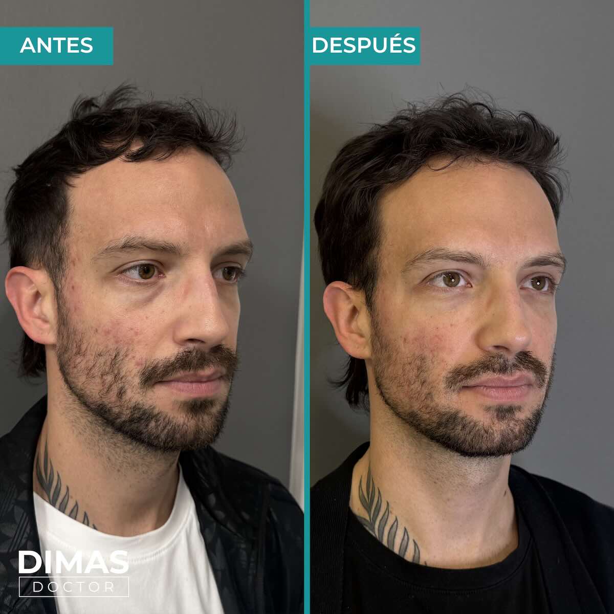 Antes y después de tratamiento con ácido hialurónico puntos de anclaje en hombre