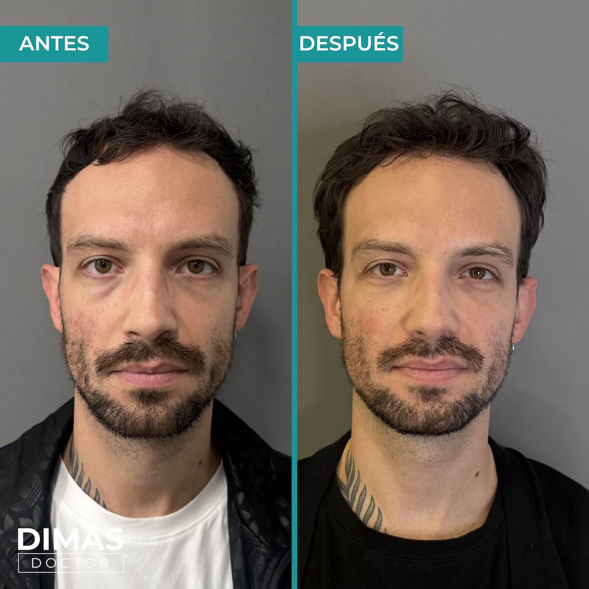 Antes y después de tratamiento con ácido hialurónico puntos de anclaje en hombre