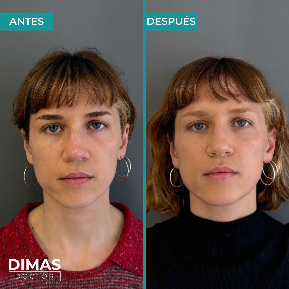 Antes y después en mujer tras recibir tratamiento de puntos de anclaje y rejuvenecimiento facial con ácido hialurónico en Barcelona
