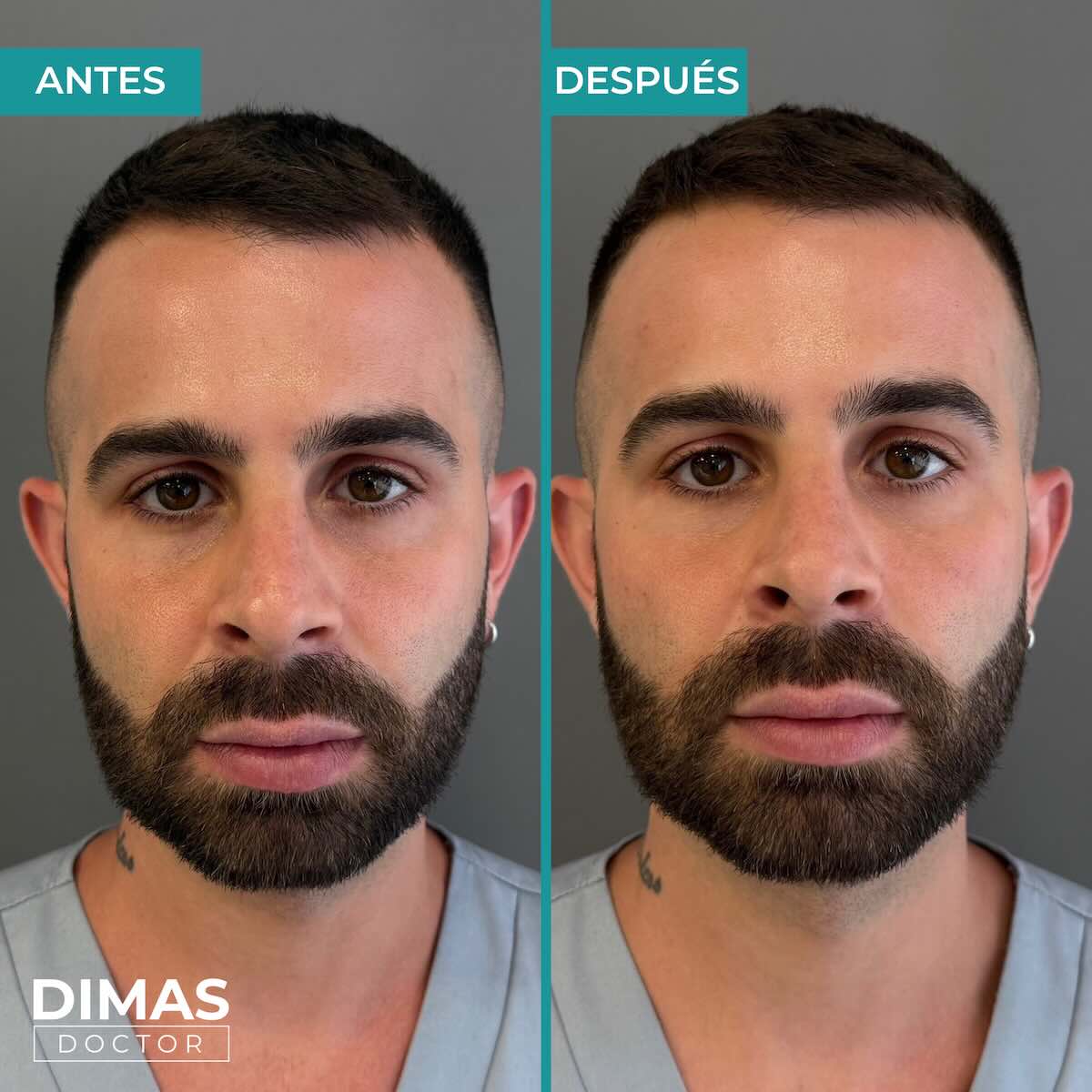 Antes y después en hombre tras recibir tratamiento de puntos de anclaje y rejuvenecimiento facial con ácido hialurónico en Barcelona