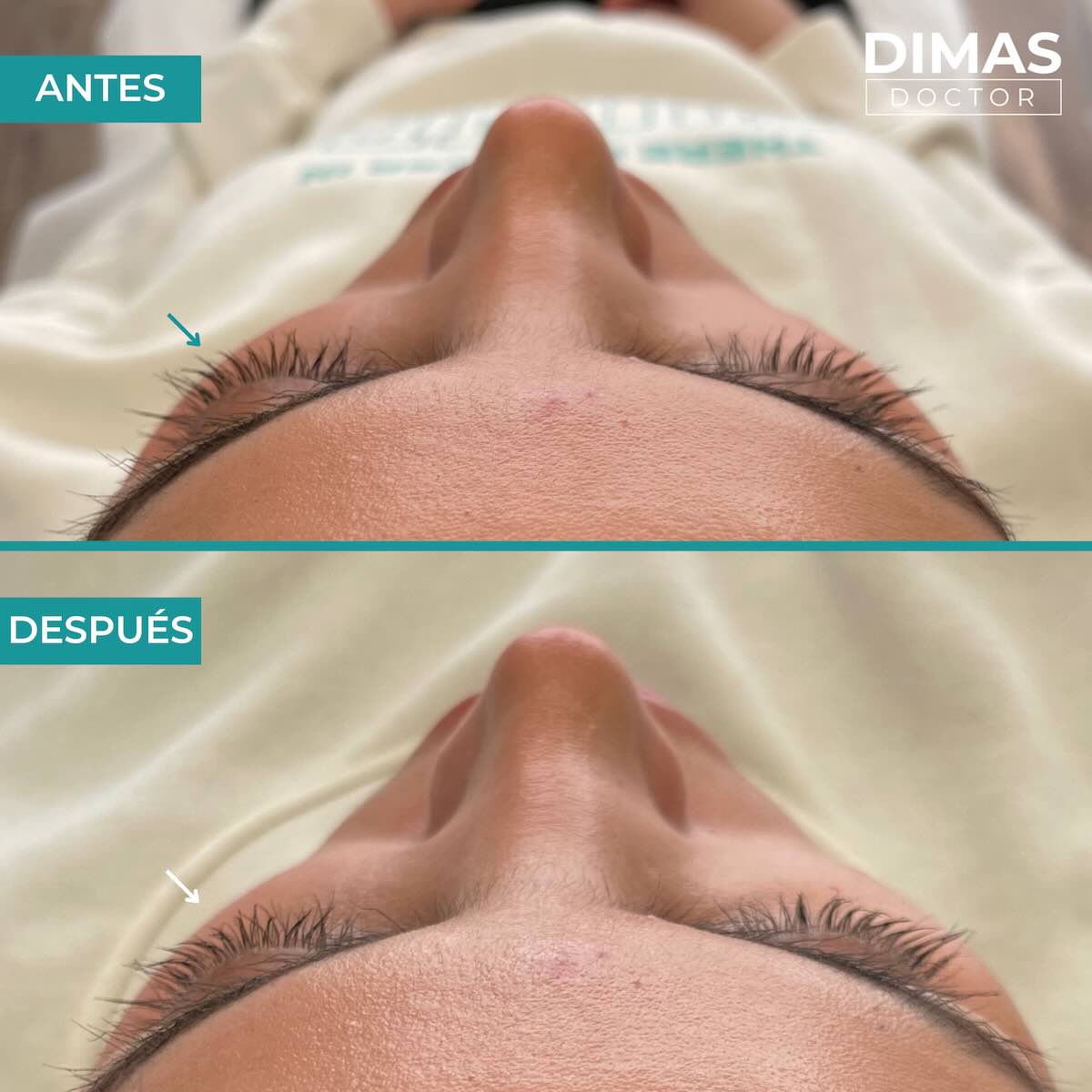 Antes y después en mujer tras recibir tratamiento de puntos de anclaje y rejuvenecimiento facial con ácido hialurónico en Barcelona