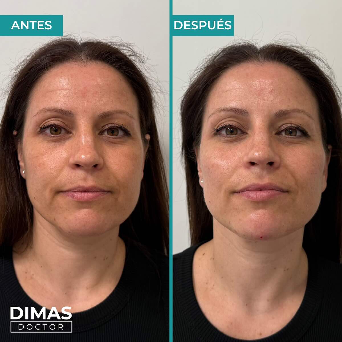 Antes y después en mujer tras recibir tratamiento de puntos de anclaje y rejuvenecimiento facial con ácido hialurónico en Barcelona
