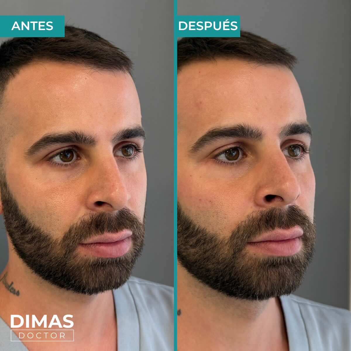 Antes y después en hombre tras recibir tratamiento de puntos de anclaje y rejuvenecimiento facial con ácido hialurónico en Barcelona