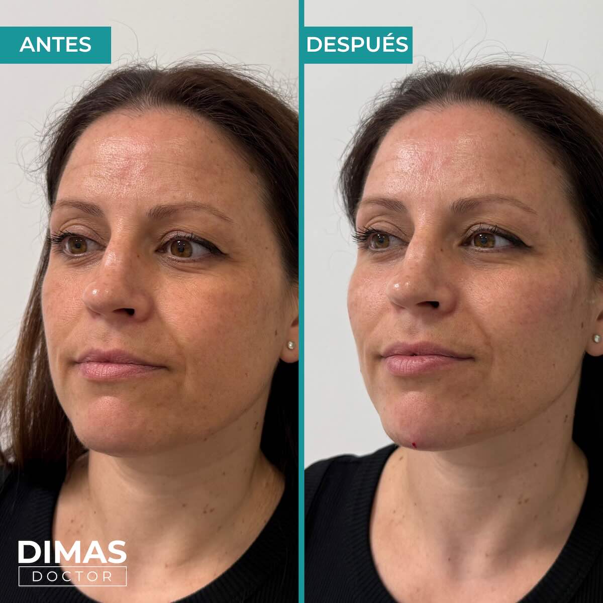 Antes y después en mujer tras recibir tratamiento de puntos de anclaje y rejuvenecimiento facial con ácido hialurónico en Barcelona