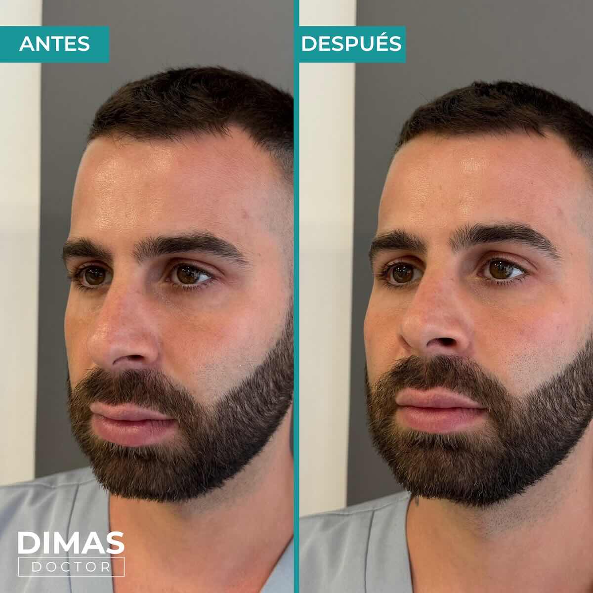 Antes y después en hombre tras recibir tratamiento de puntos de anclaje y rejuvenecimiento facial con ácido hialurónico en Barcelona