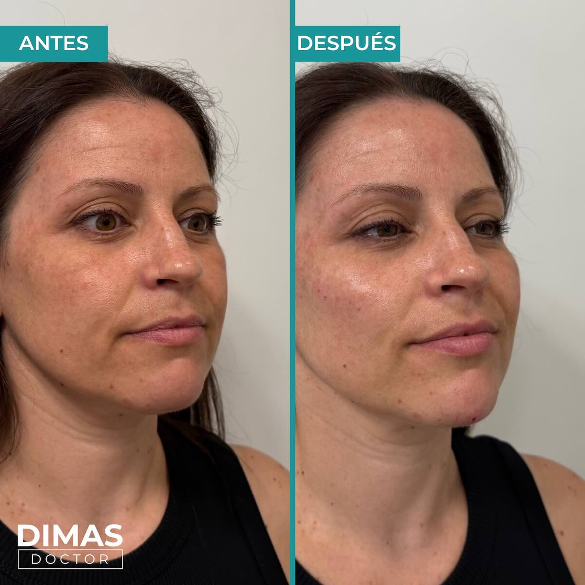 Antes y después en mujer tras recibir tratamiento de puntos de anclaje y rejuvenecimiento facial con ácido hialurónico en Barcelona