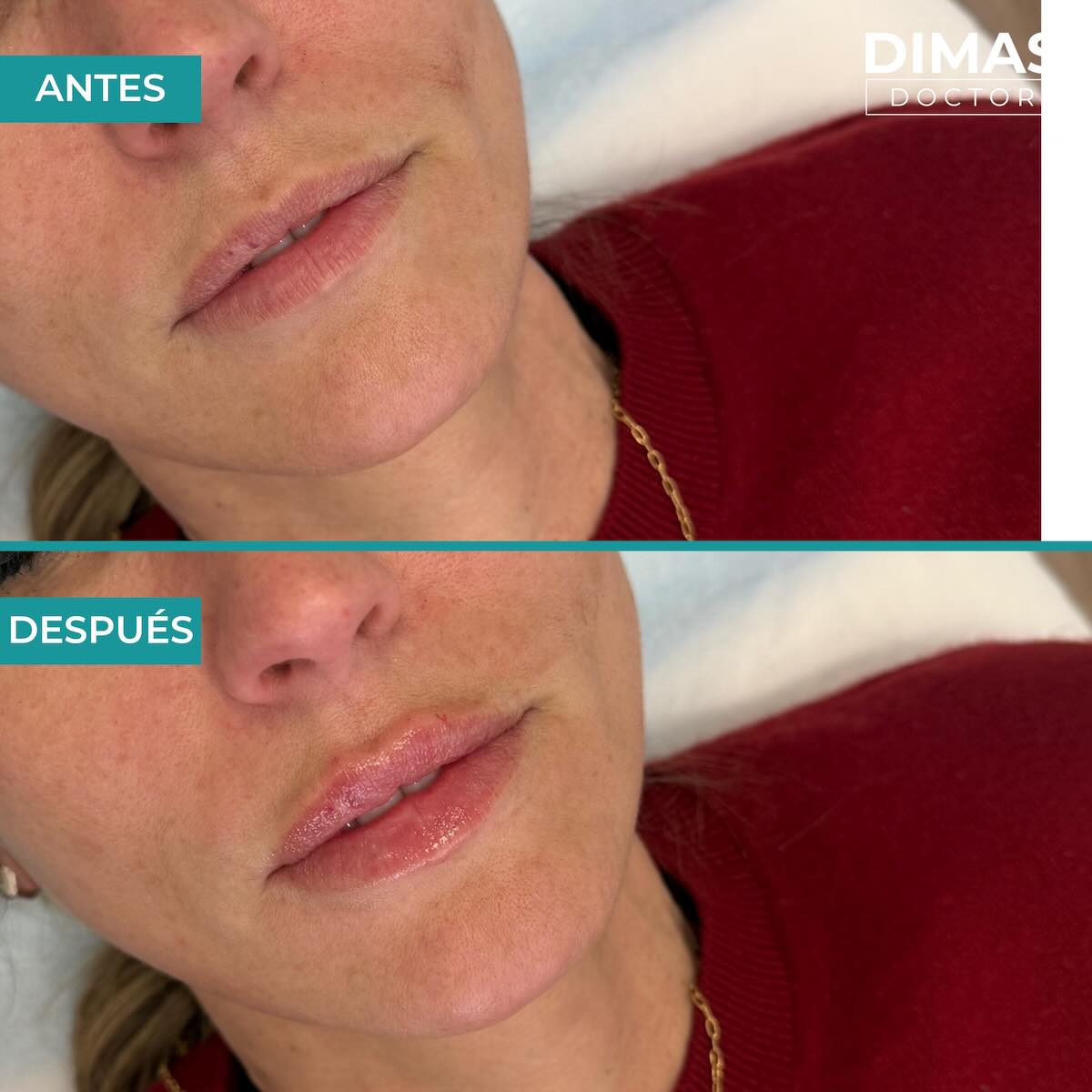 Relleno de labios con ácido hialurónico en mujeres en Barcelona