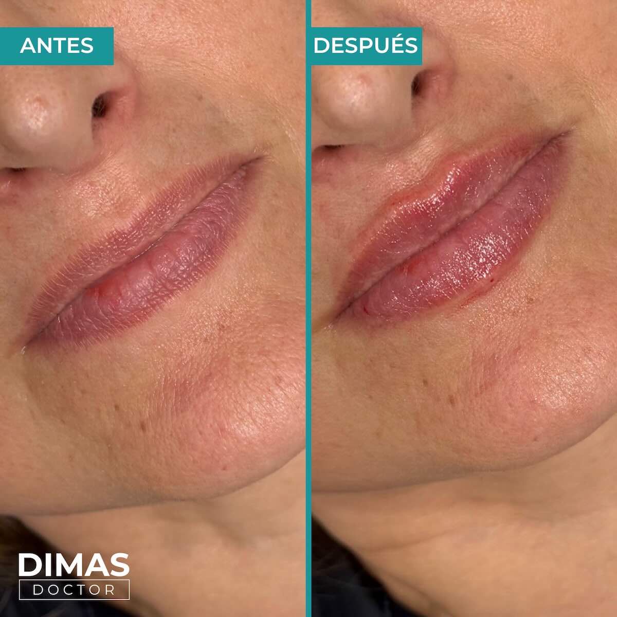 Relleno de labios con ácido hialurónico en mujeres en Barcelona