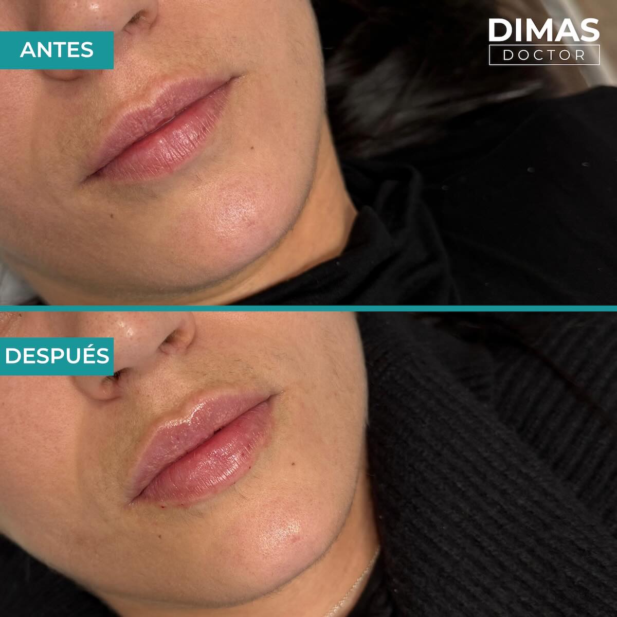 Relleno de labios con ácido hialurónico en mujeres en Barcelona