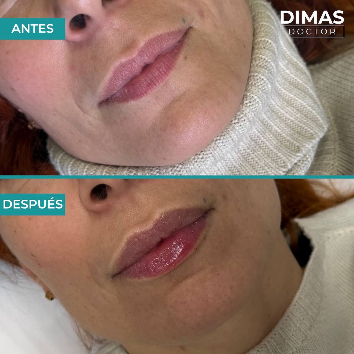 Relleno de labios con ácido hialurónico en mujeres en Barcelona