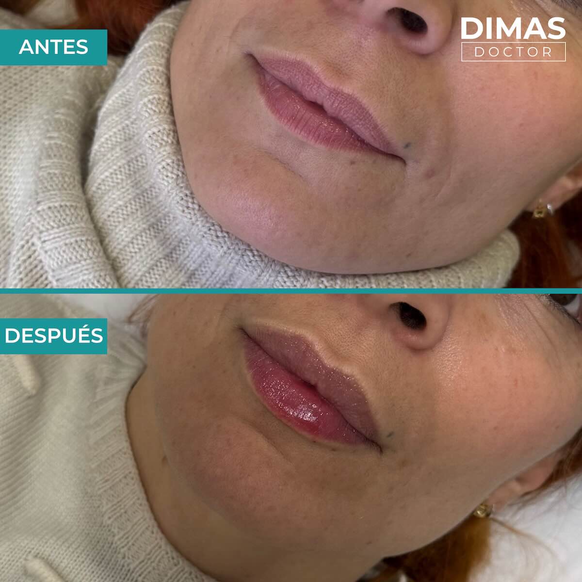 Relleno de labios con ácido hialurónico en mujeres en Barcelona