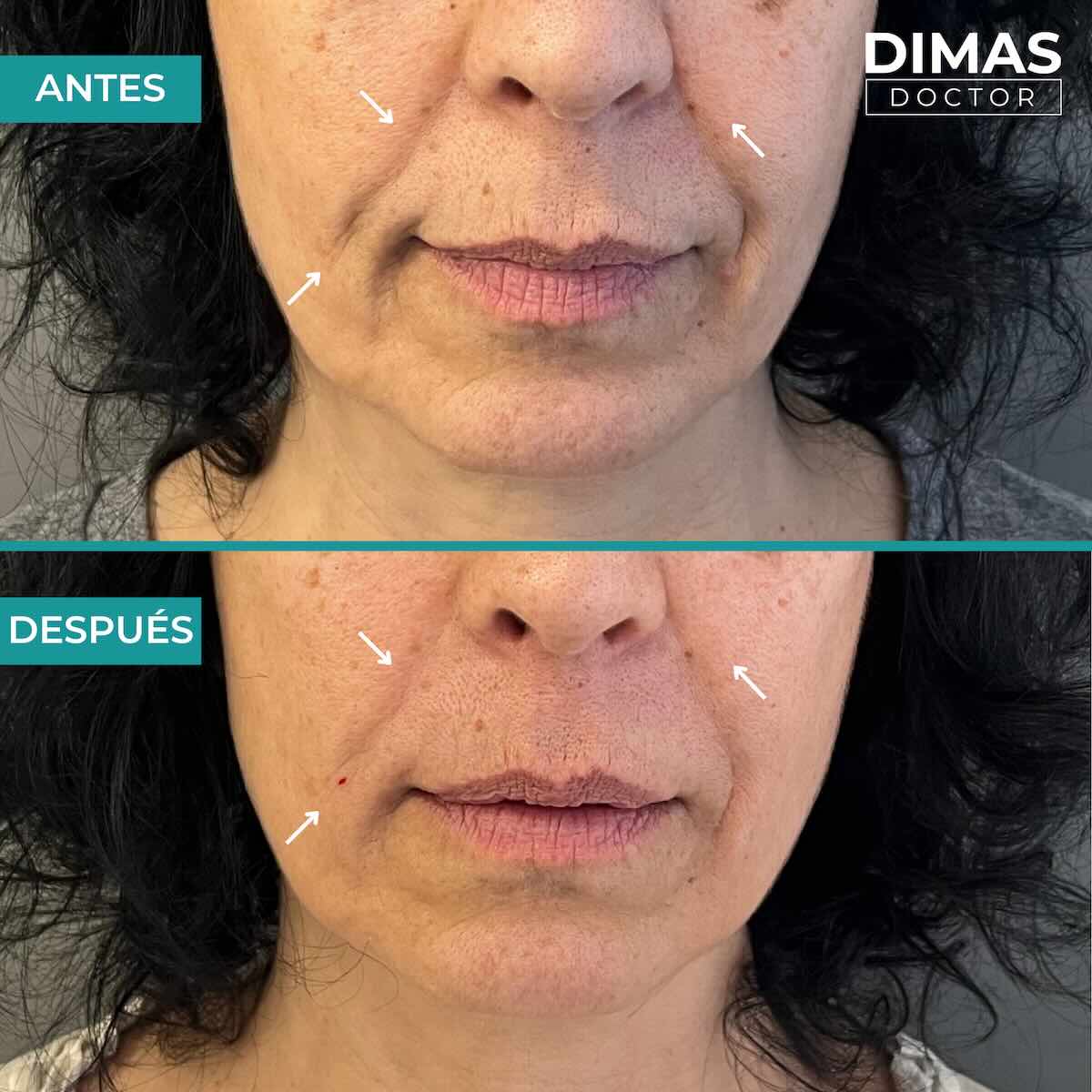 Antes y después de rellenar con ácido hialurónico el surco nasogeniano en una mujer