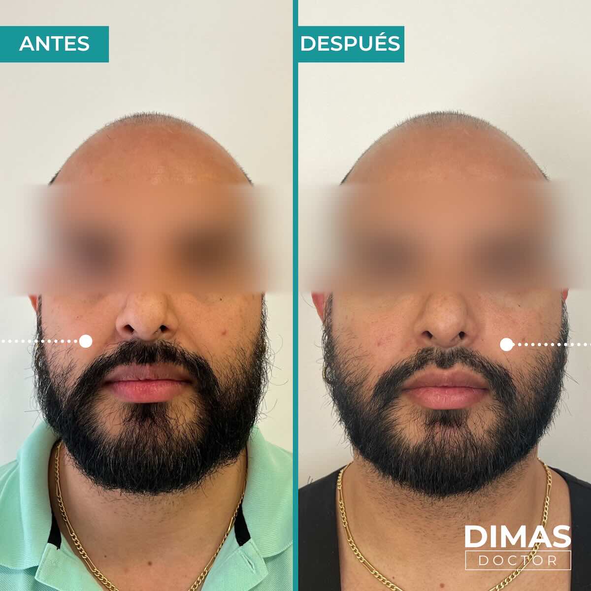 Antes y después de rellenar con ácido hialurónico el surco nasogeniano en un hombre