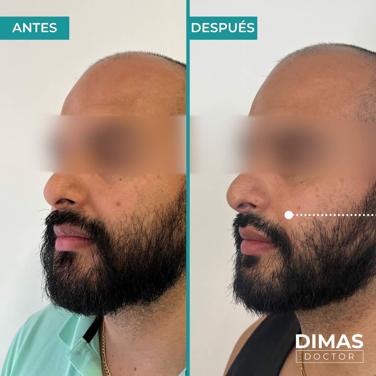 Antes y después de rellenar con ácido hialurónico el surco nasogeniano en un hombre