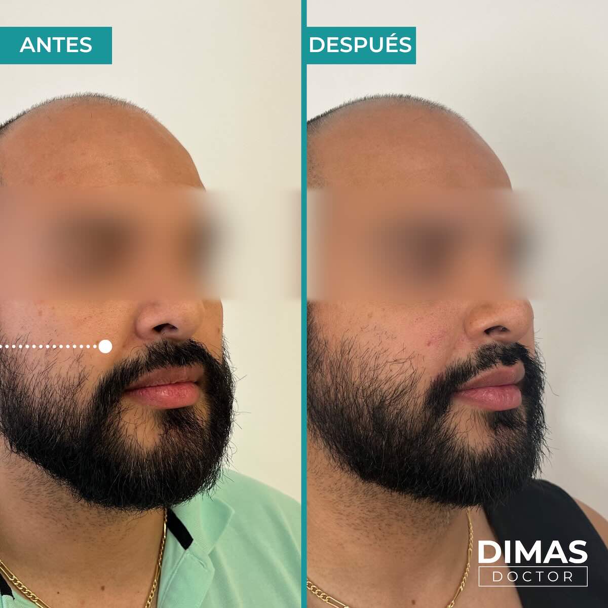 Antes y después de rellenar con ácido hialurónico el surco nasogeniano en un hombre