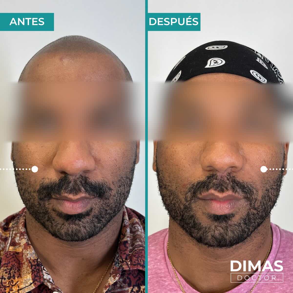 Antes y después de rellenar con ácido hialurónico el surco nasogeniano en un hombre