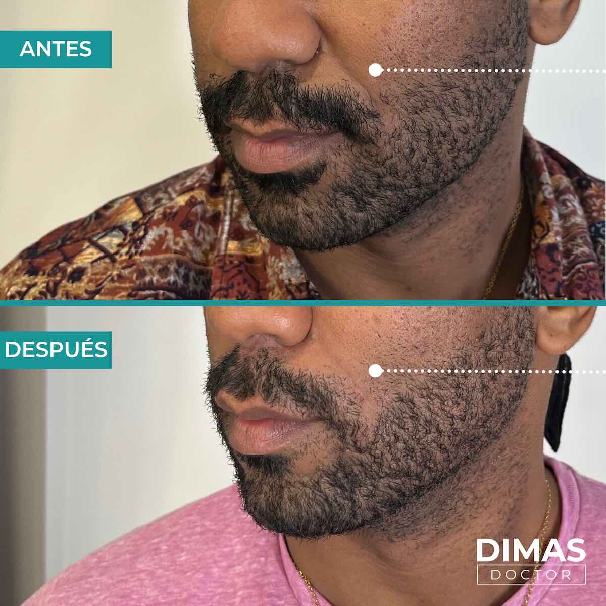 Antes y después de rellenar con ácido hialurónico el surco nasogeniano en un hombre