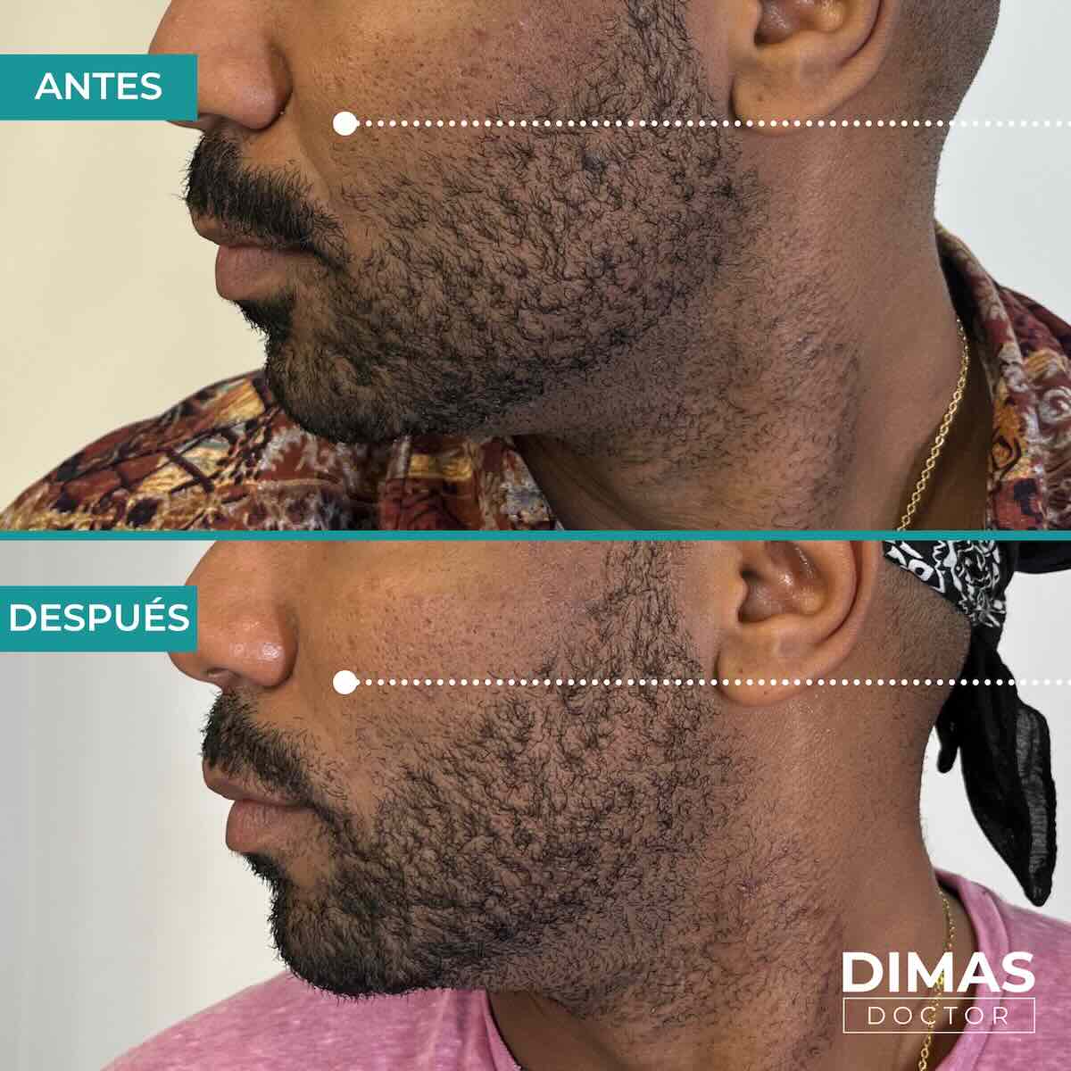 Antes y después de rellenar con ácido hialurónico el surco nasogeniano en un hombre