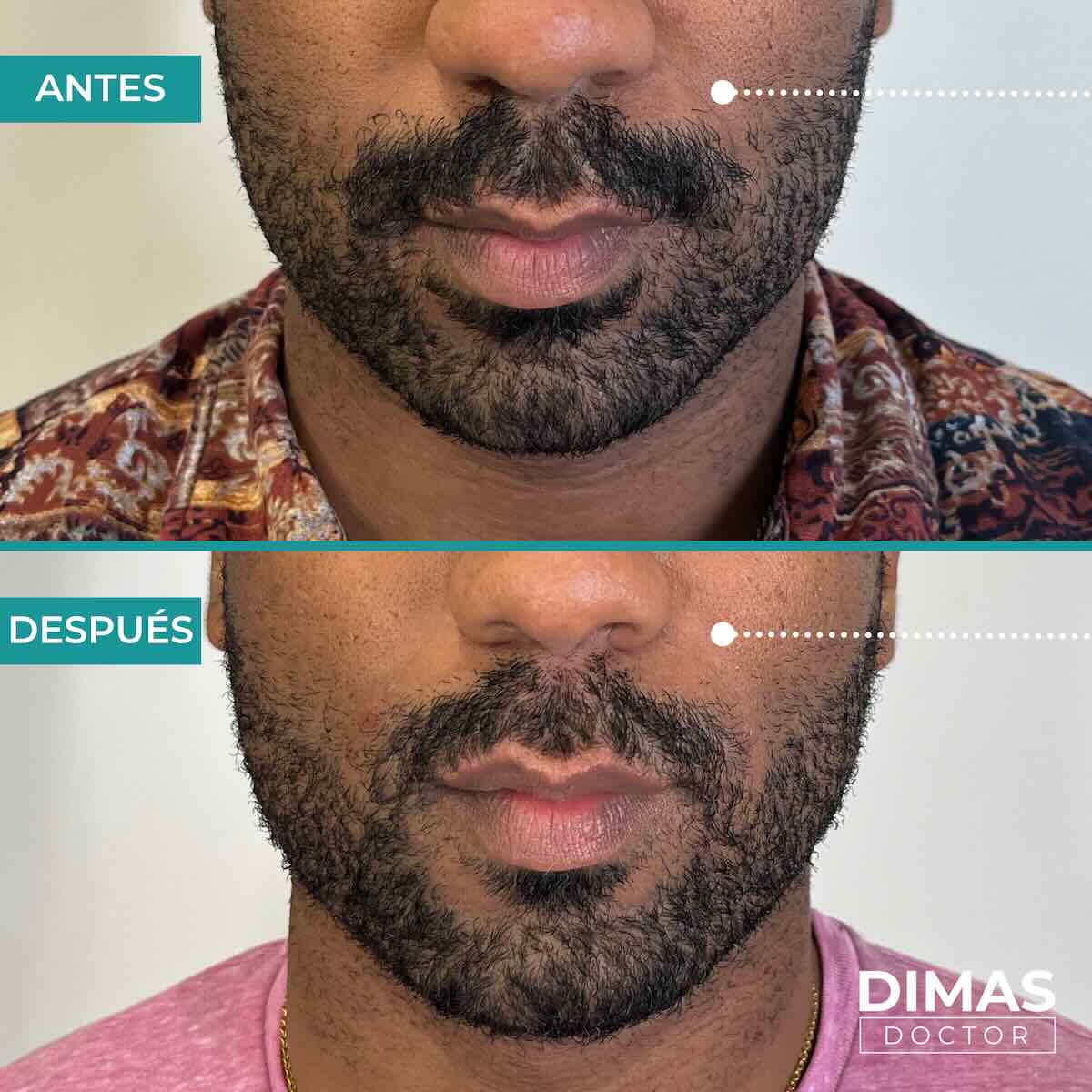 Antes y después de rellenar con ácido hialurónico el surco nasogeniano en un hombre