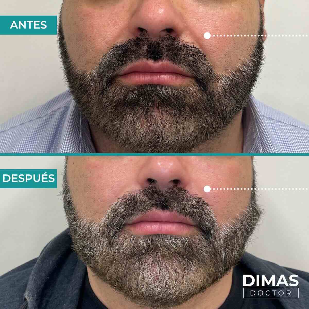 Antes y después de rellenar con ácido hialurónico el surco nasogeniano en un hombre