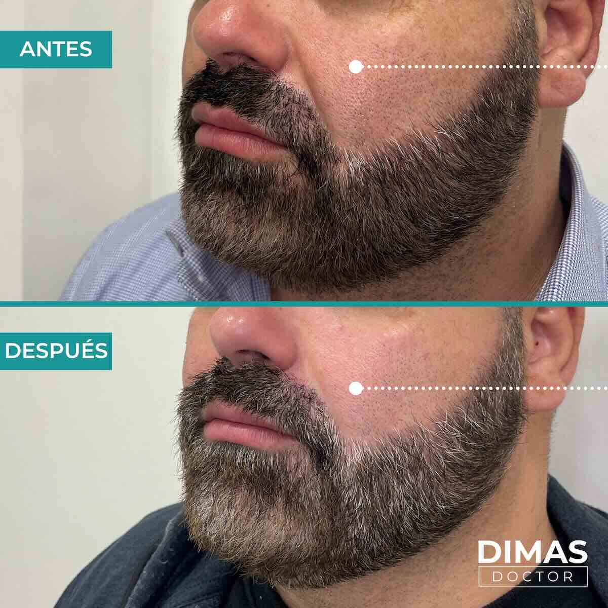 Antes y después de rellenar con ácido hialurónico el surco nasogeniano en un hombre