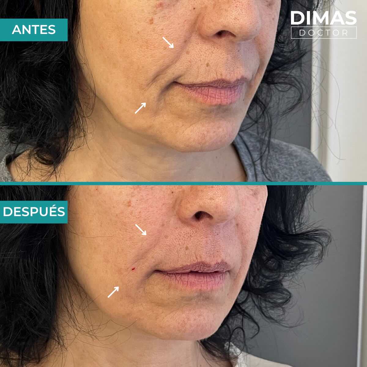 Antes y después de rellenar con ácido hialurónico el surco nasogeniano en una mujer