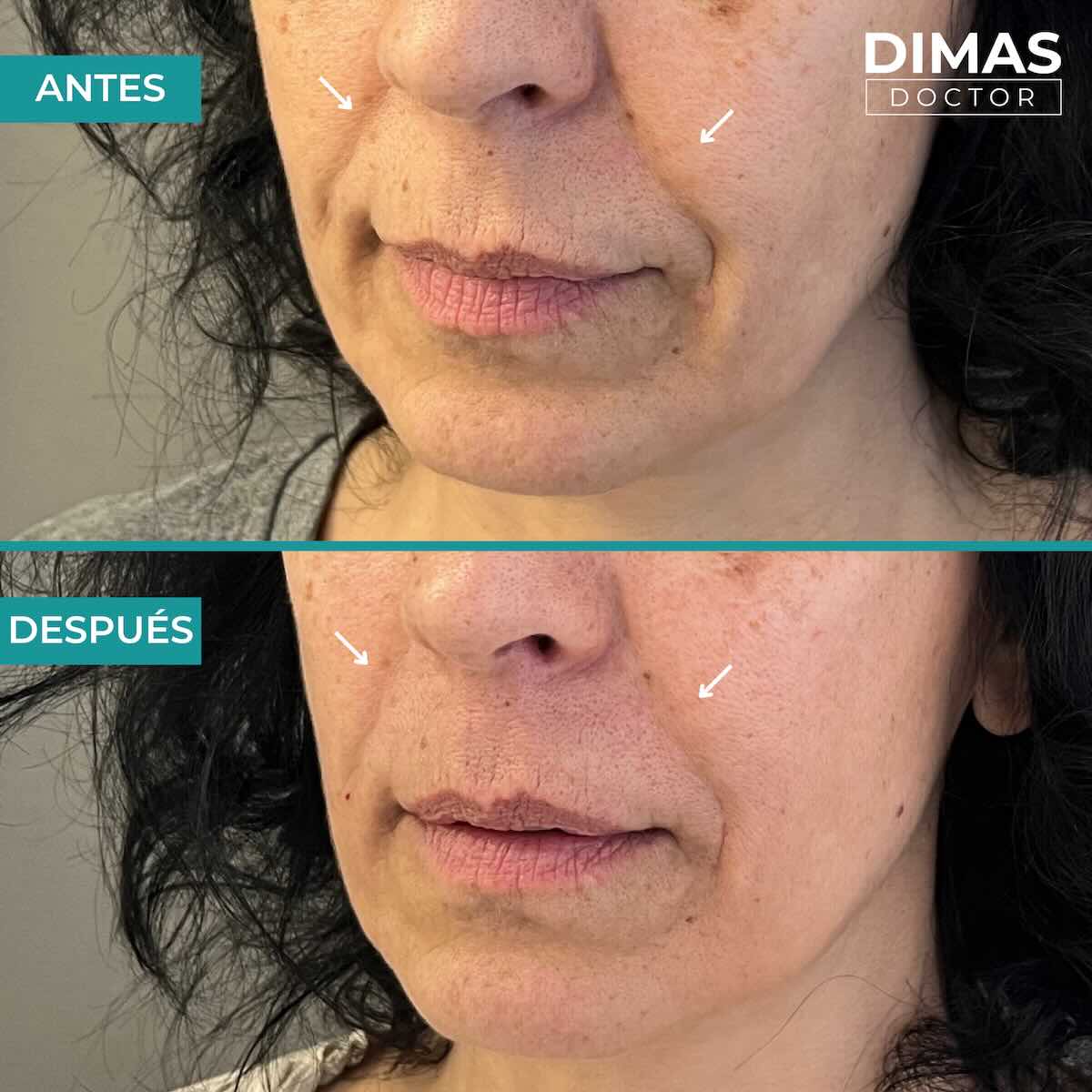 Antes y después de rellenar con ácido hialurónico el surco nasogeniano en una mujer