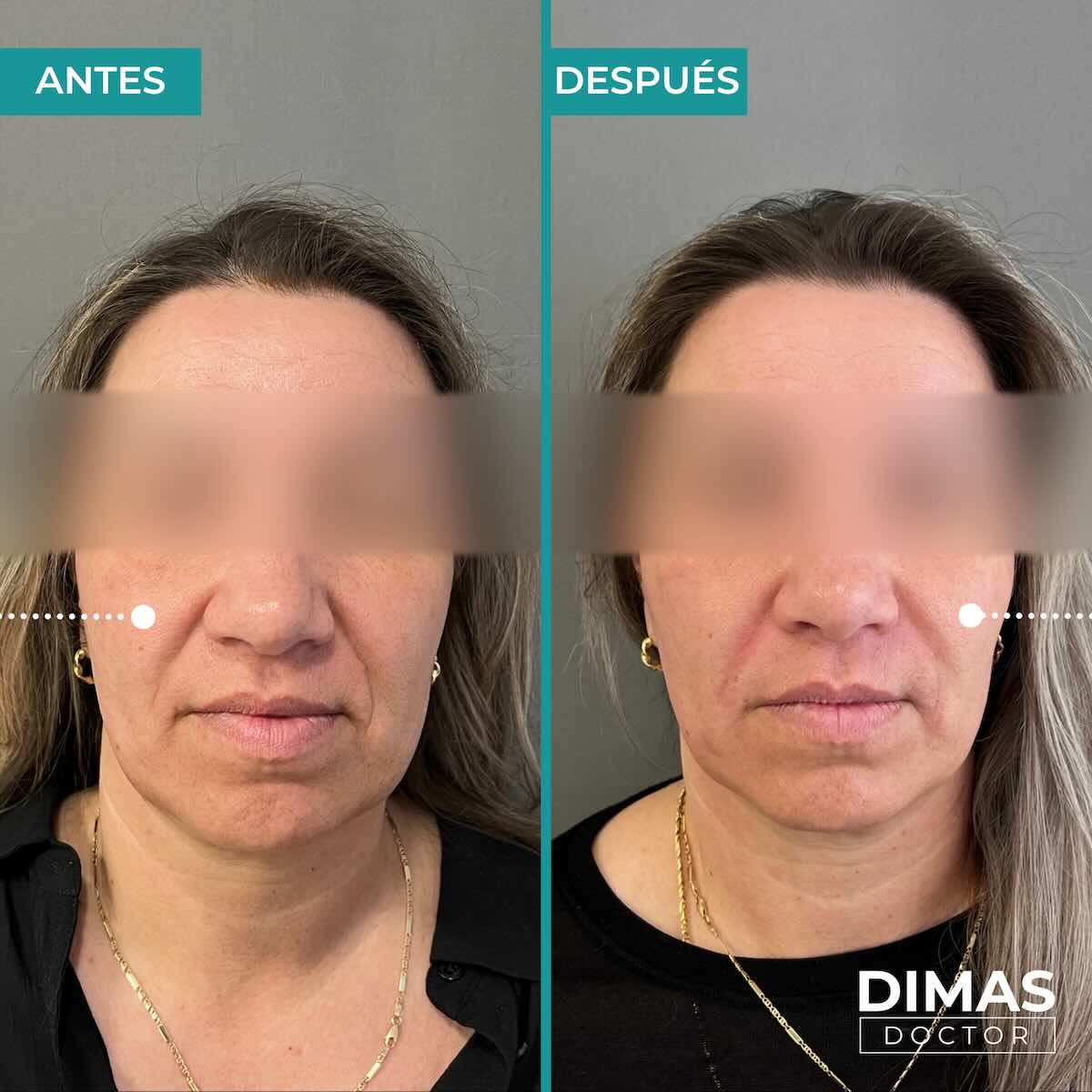 Antes y después de rellenar con ácido hialurónico el surco nasogeniano en una mujer
