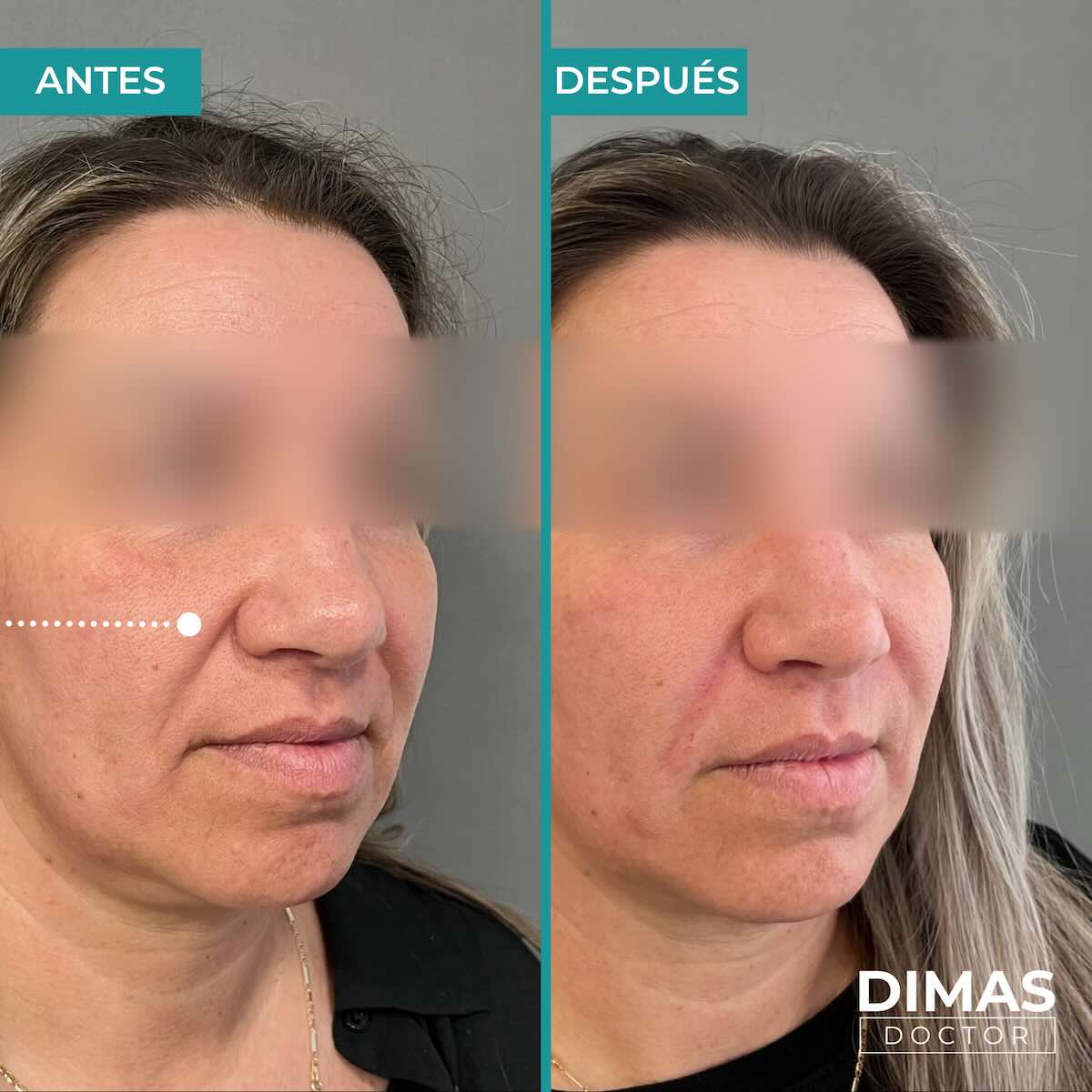 Antes y después de rellenar con ácido hialurónico el surco nasogeniano en una mujer