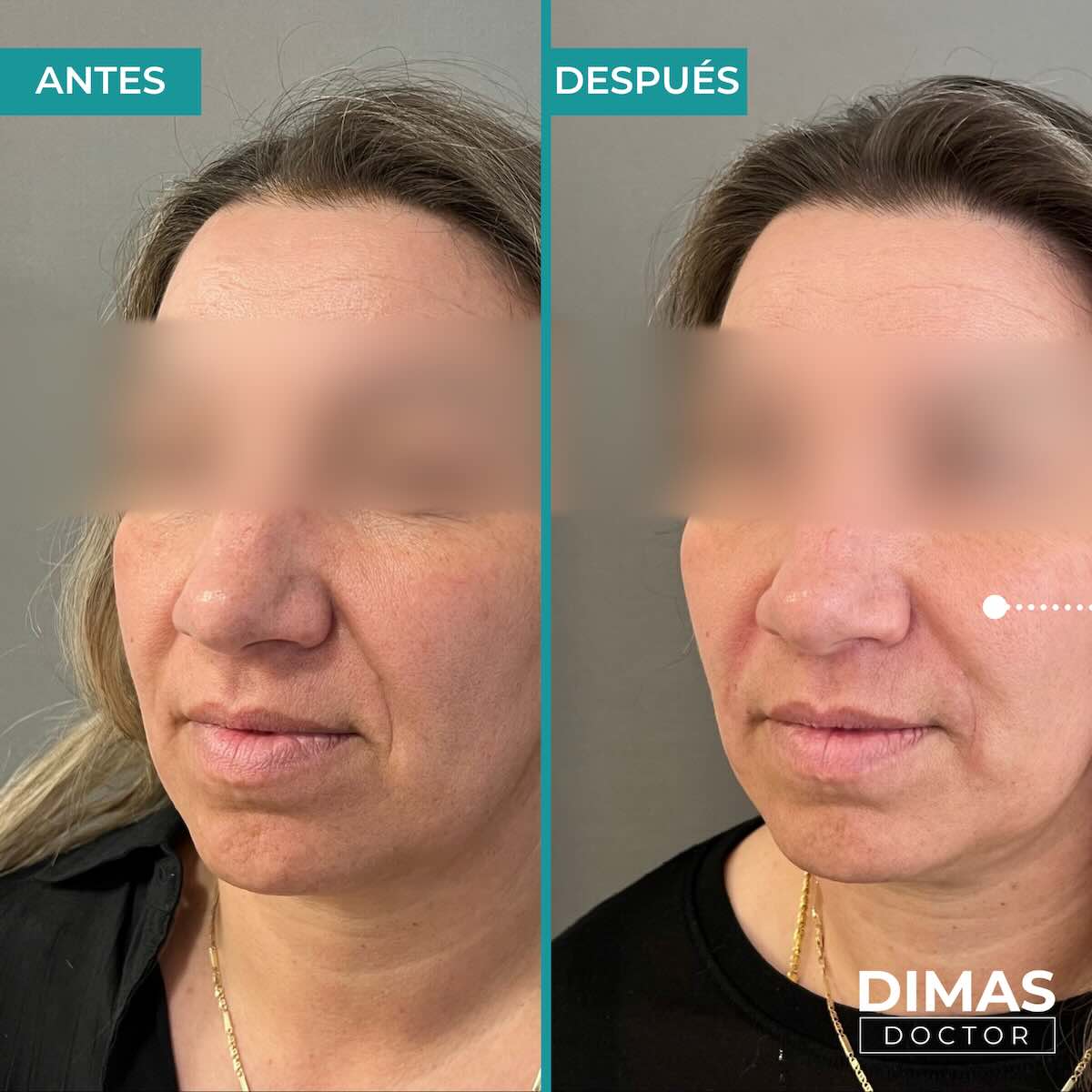 Antes y después de rellenar con ácido hialurónico el surco nasogeniano en una mujer