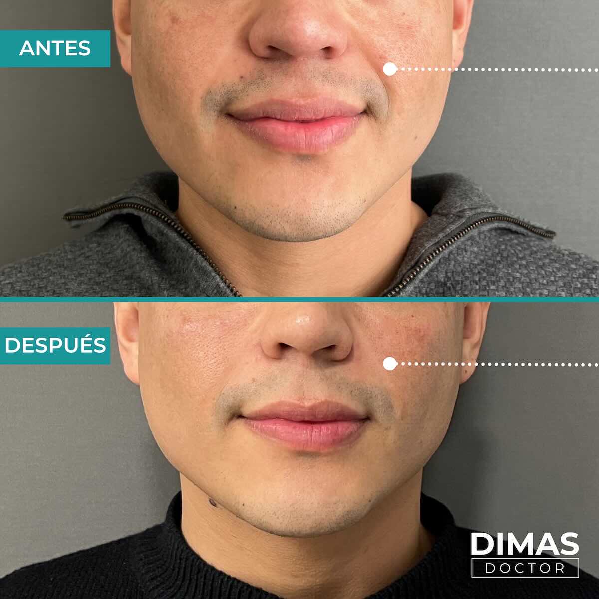 Antes y después de rellenar con ácido hialurónico el surco nasogeniano en un hombre