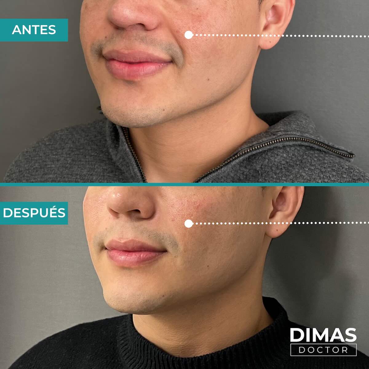 Antes y después de rellenar con ácido hialurónico el surco nasogeniano en un hombre