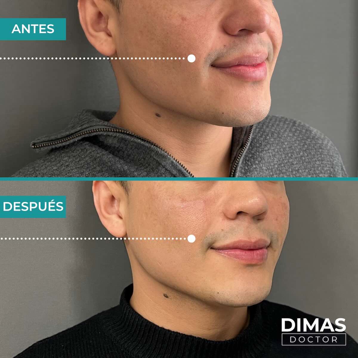 Antes y después de rellenar con ácido hialurónico el surco nasogeniano en un hombre