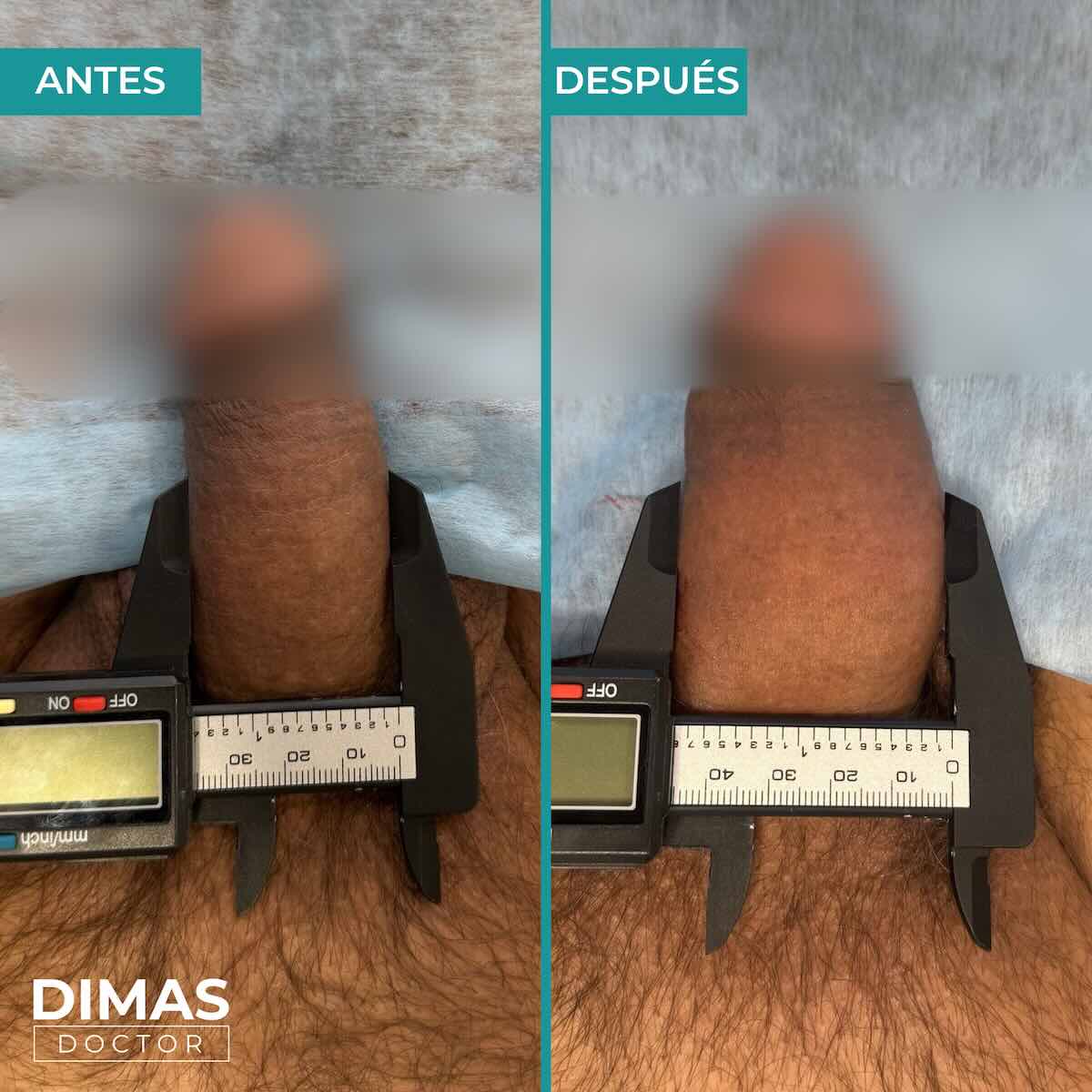 Antes y después mostrando el aumento de grosos del pene con un medidor
