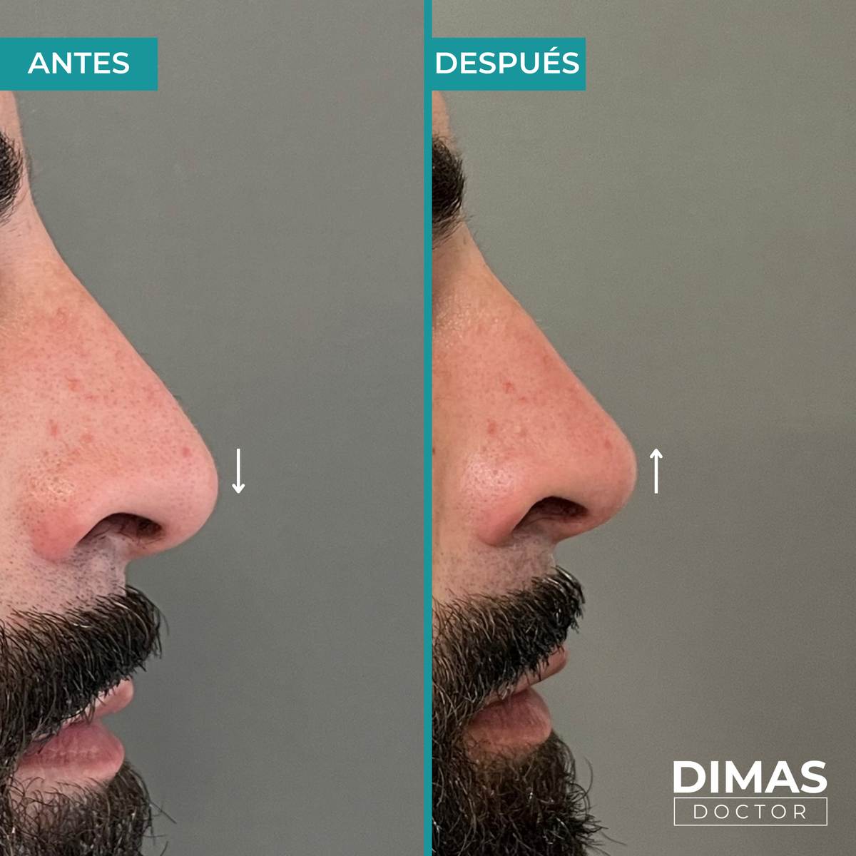 Antes y después de rinomodelación con ácido hialurónico en hombre – elevación de punta nasal caída en perfil lateral, Dimas Doctor Barcelona