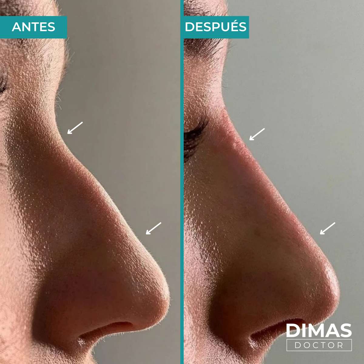 Primer plano antes y después de rinomodelación con ácido hialurónico – corrección del dorso y punta nasal en hombre, Barcelona