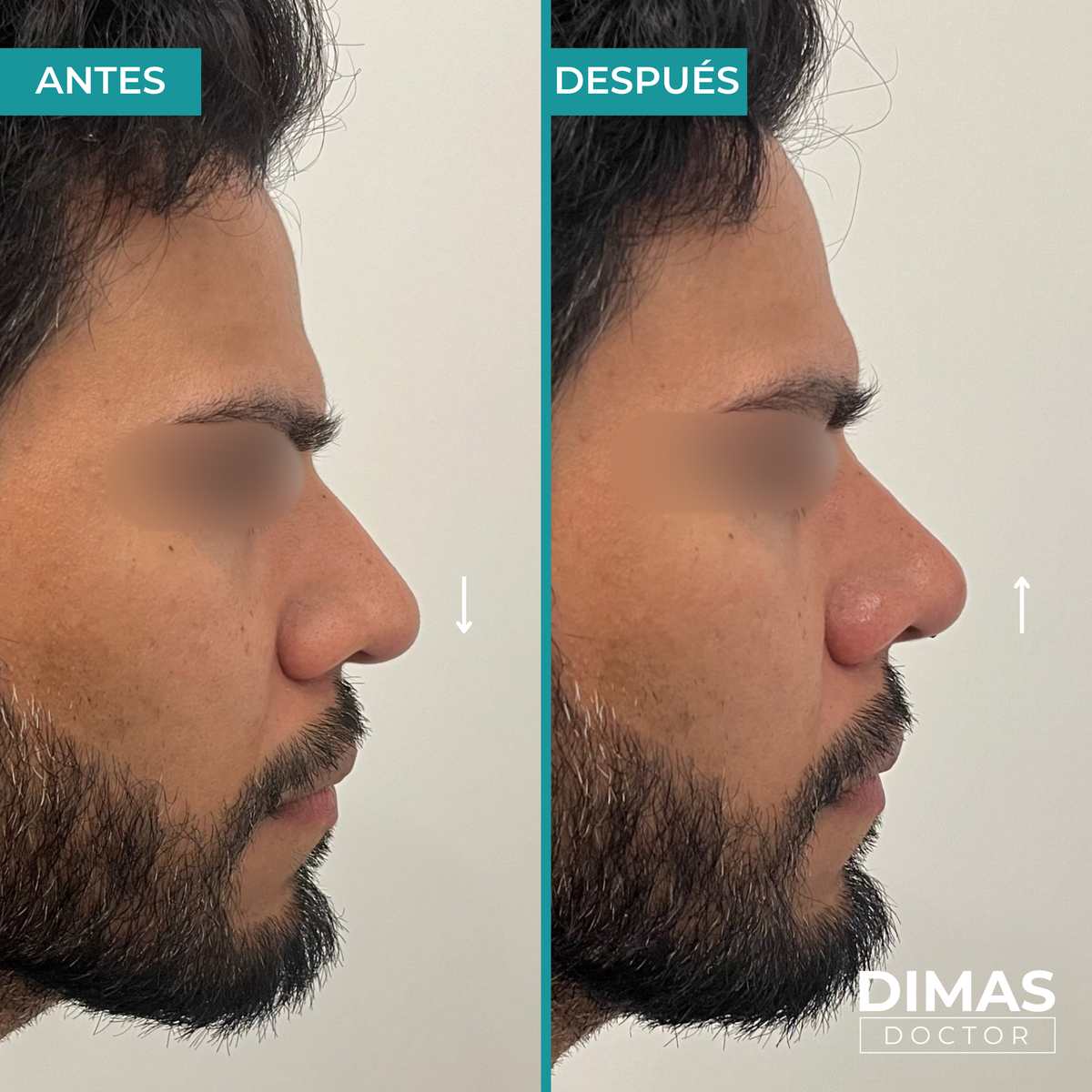 Resultado antes y después de rinomodelación con ácido hialurónico en hombre – perfil lateral con elevación de punta nasal, Dimas Doctor Barcelona