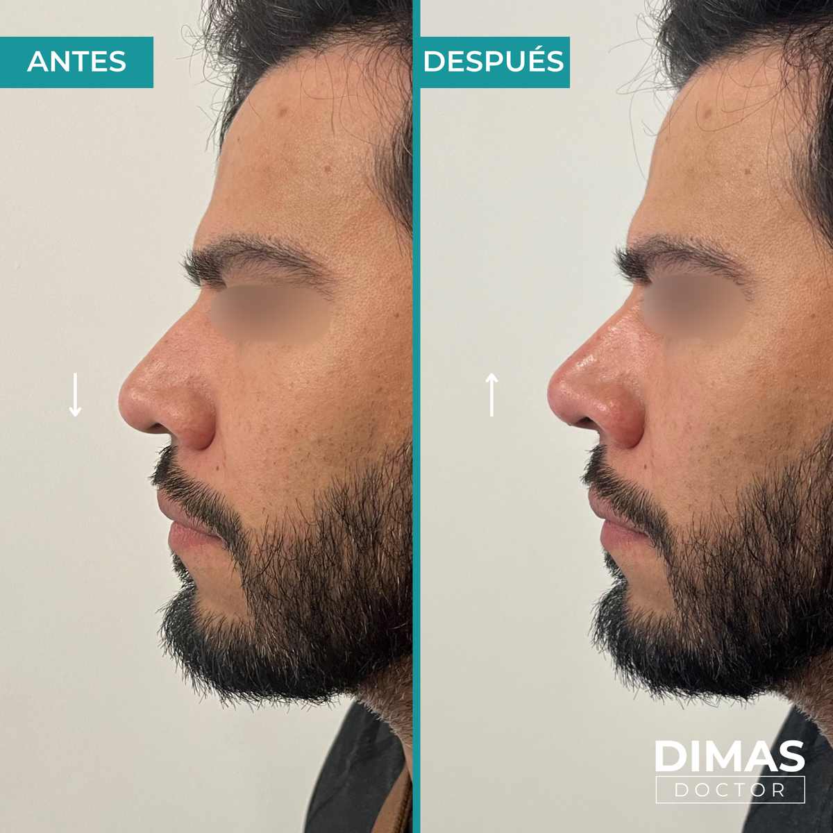 Antes y después de rinomodelación con ácido hialurónico en hombre – corrección de punta caída vista en perfil, Barcelona