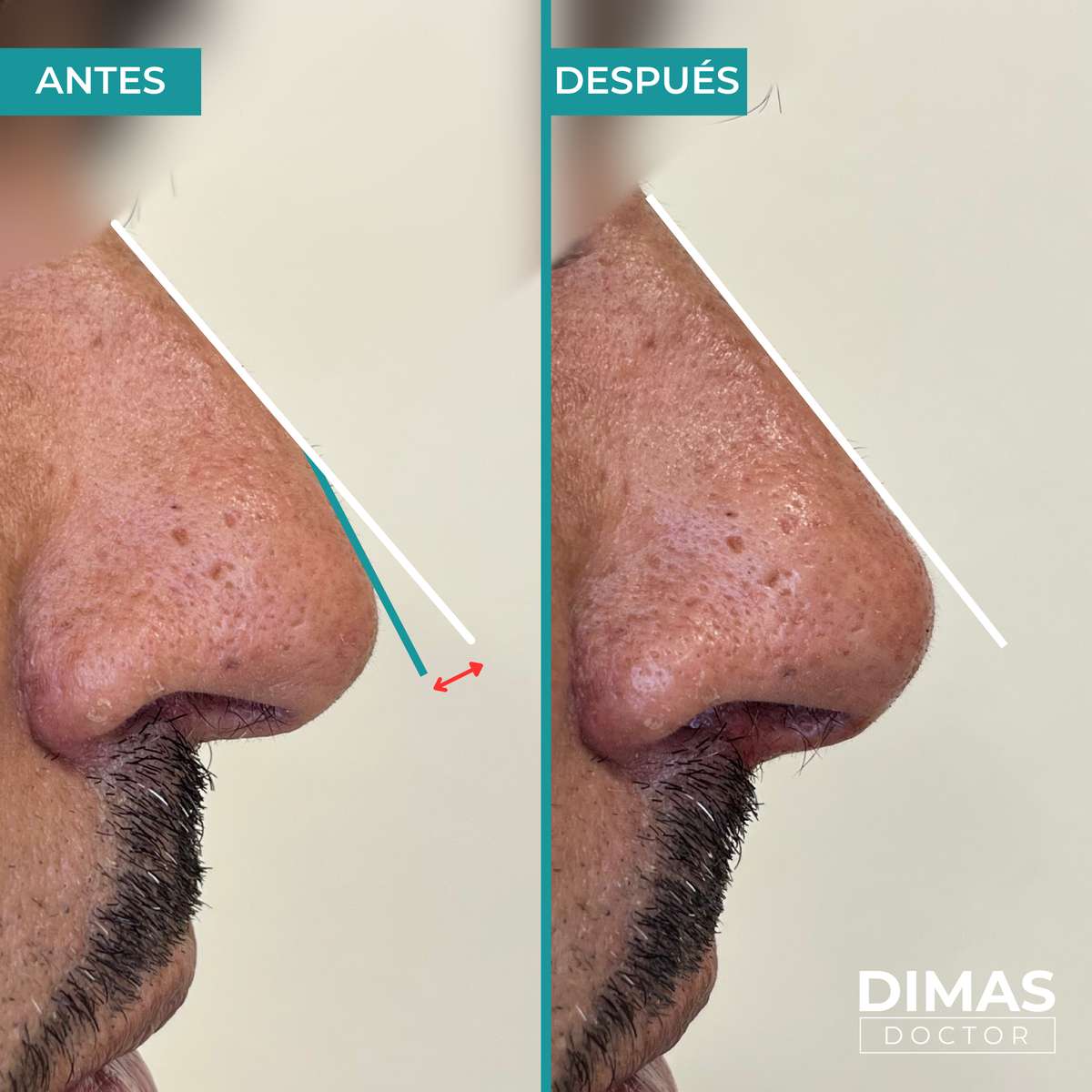Antes y después de rinomodelación sin cirugía en hombre – corrección de giba nasal y ángulo nasolabial con ácido hialurónico, Barcelona