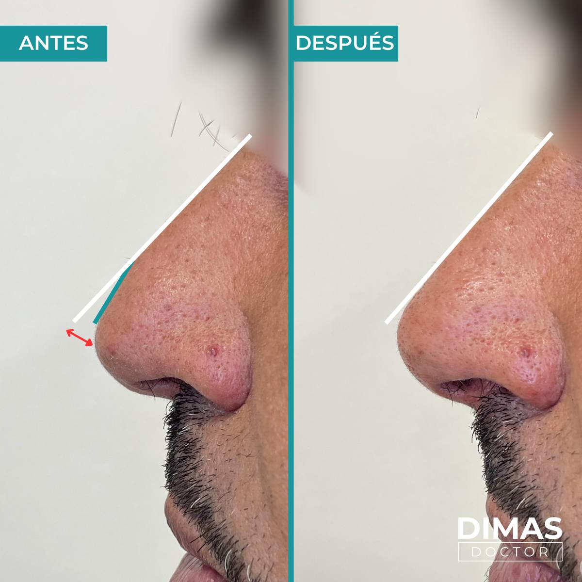Primer plano antes y después de rinomodelación con ácido hialurónico en hombre – corrección de giba en el dorso nasal, Dimas Doctor Barcelona