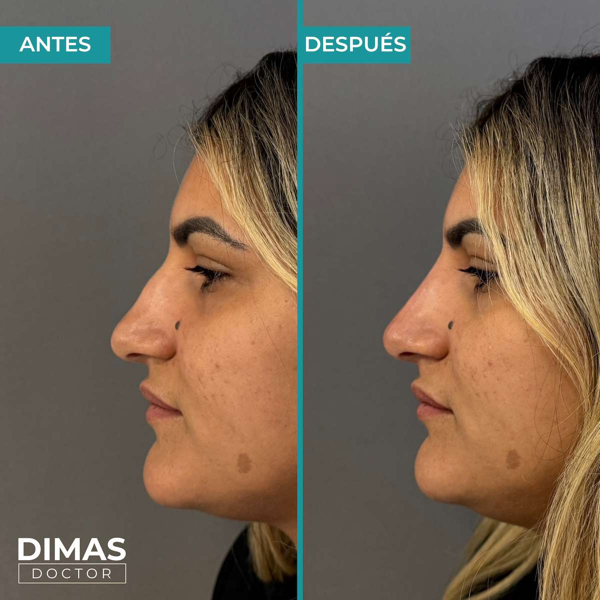 Antes y después de rinomodelación con ácido hialurónico en mujer – perfil lateral con nariz estilizada, Dimas Doctor Barcelona