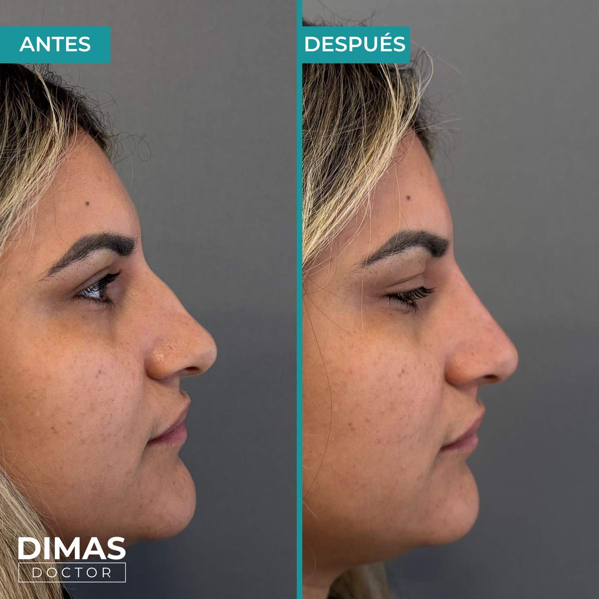 Resultado antes y después de rinomodelación con ácido hialurónico en mujer – vista en tres cuartos con perfil nasal mejorado, Barcelona