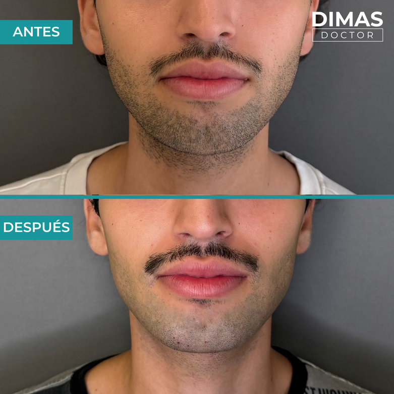 Tratamiento de relleno de mentón con ácido hialurónico en Barcelona – perfil definido